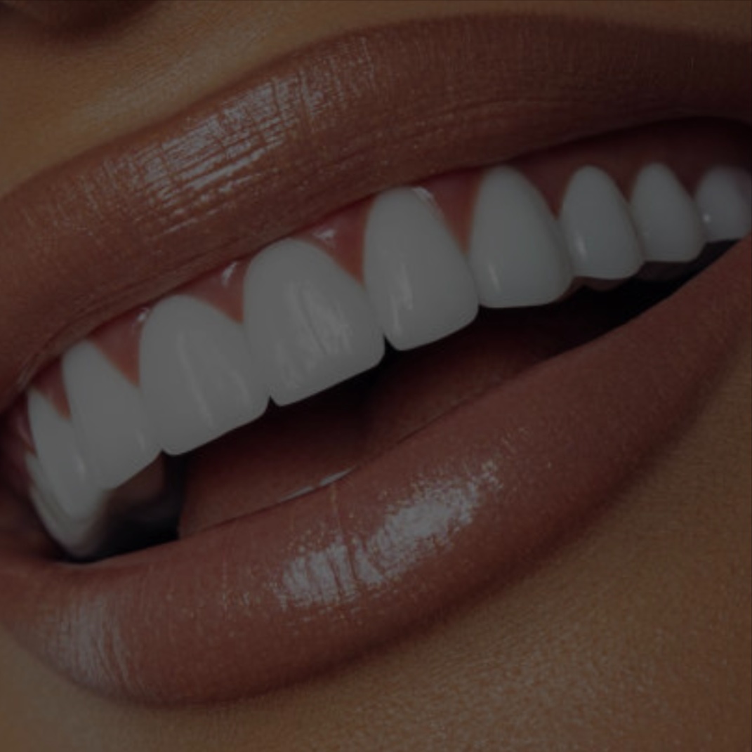 Cosmetic Teeth Whitening