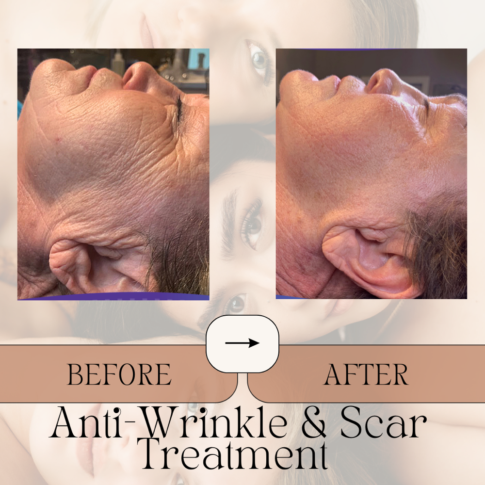 Face ONLY - Anti-Wrinkle/Scar TX