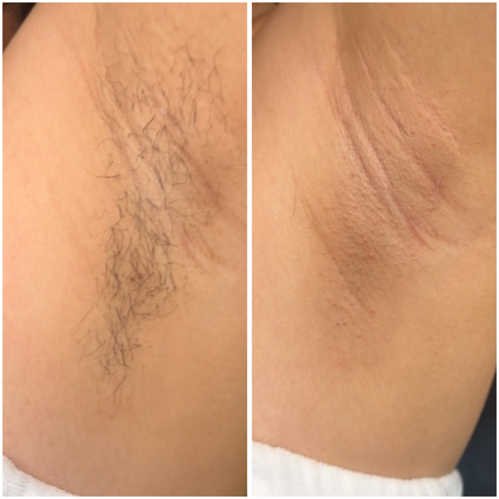 Underarm Wax