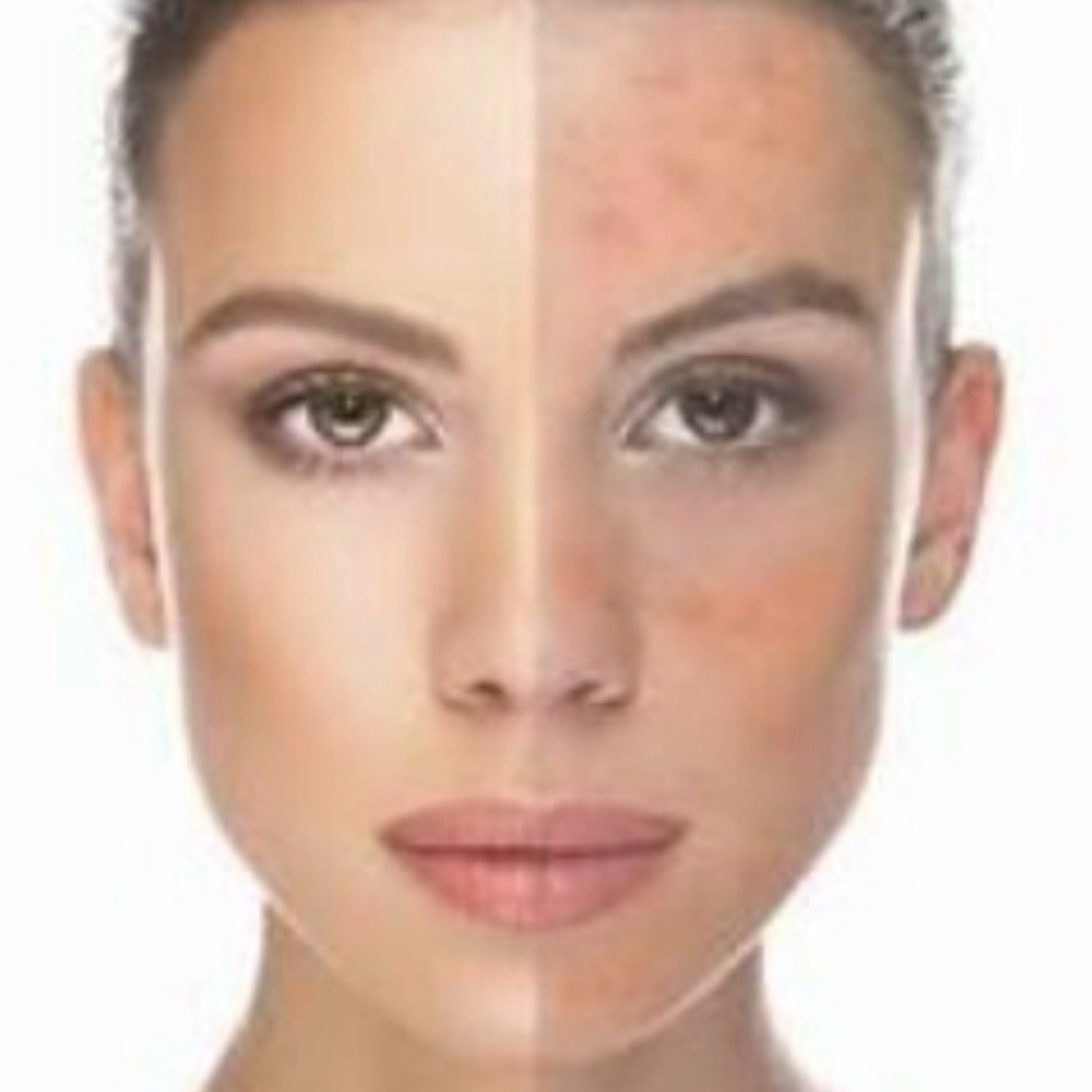 Clearskin Calming Acne Facial