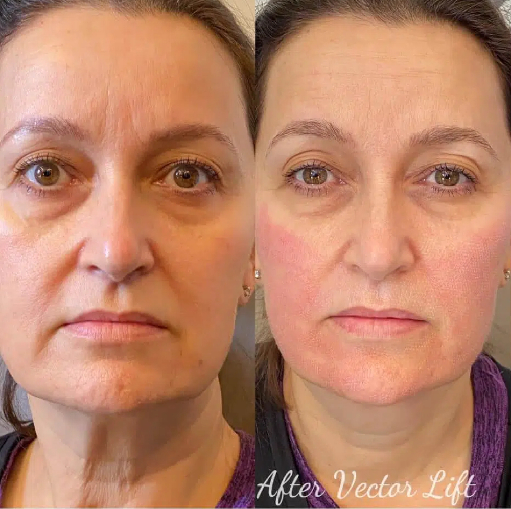 Bio-Lift at ReGenerations Medi Spa in Radcliff, KY