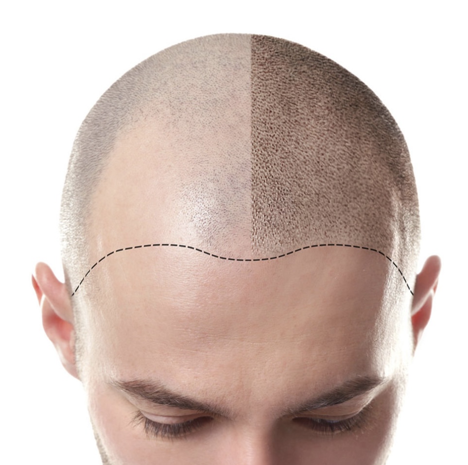 Scalp Micropigmentation