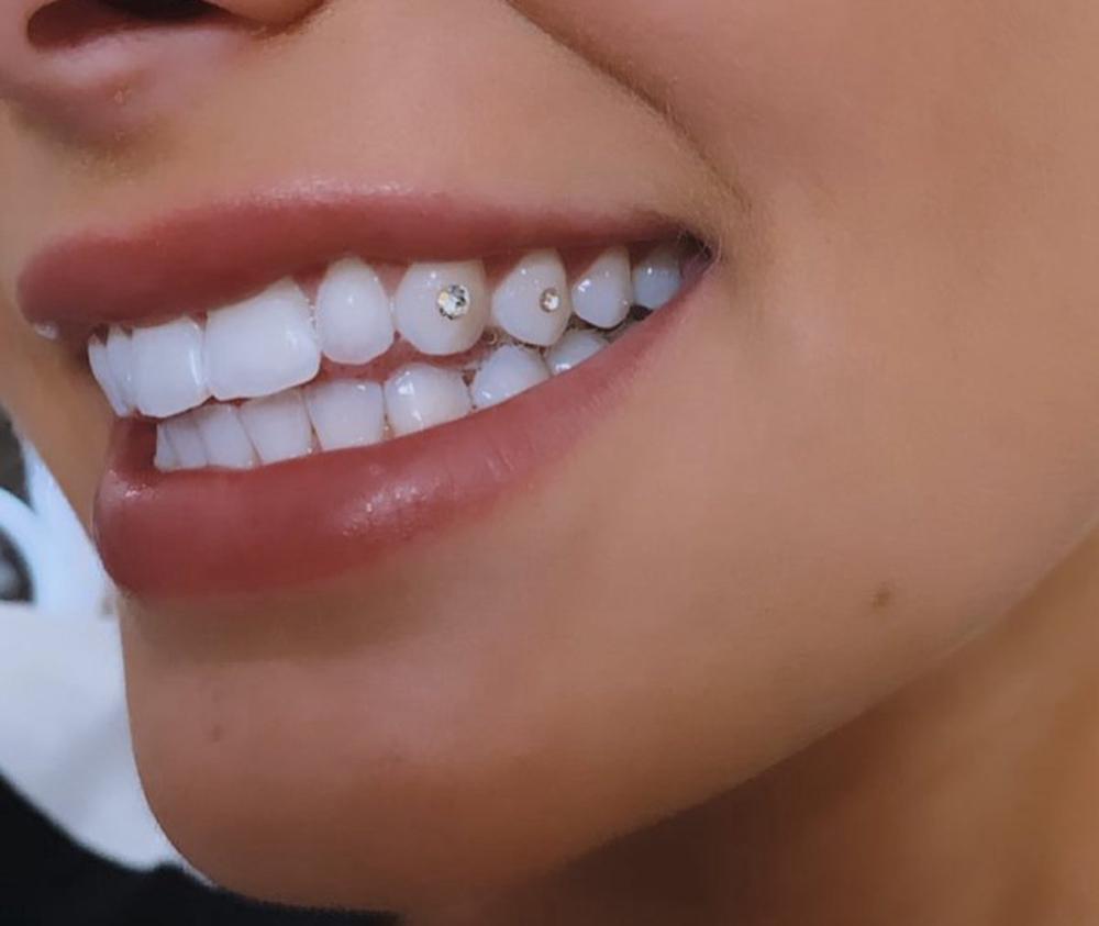 Tooth Gems