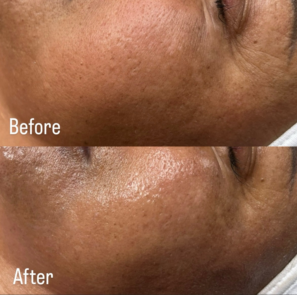 Chemical Peel