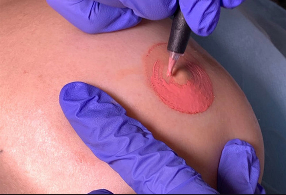 Paramedical Areola Reconstruction –