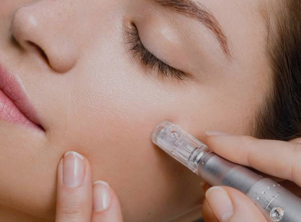 Microneedling Treatment