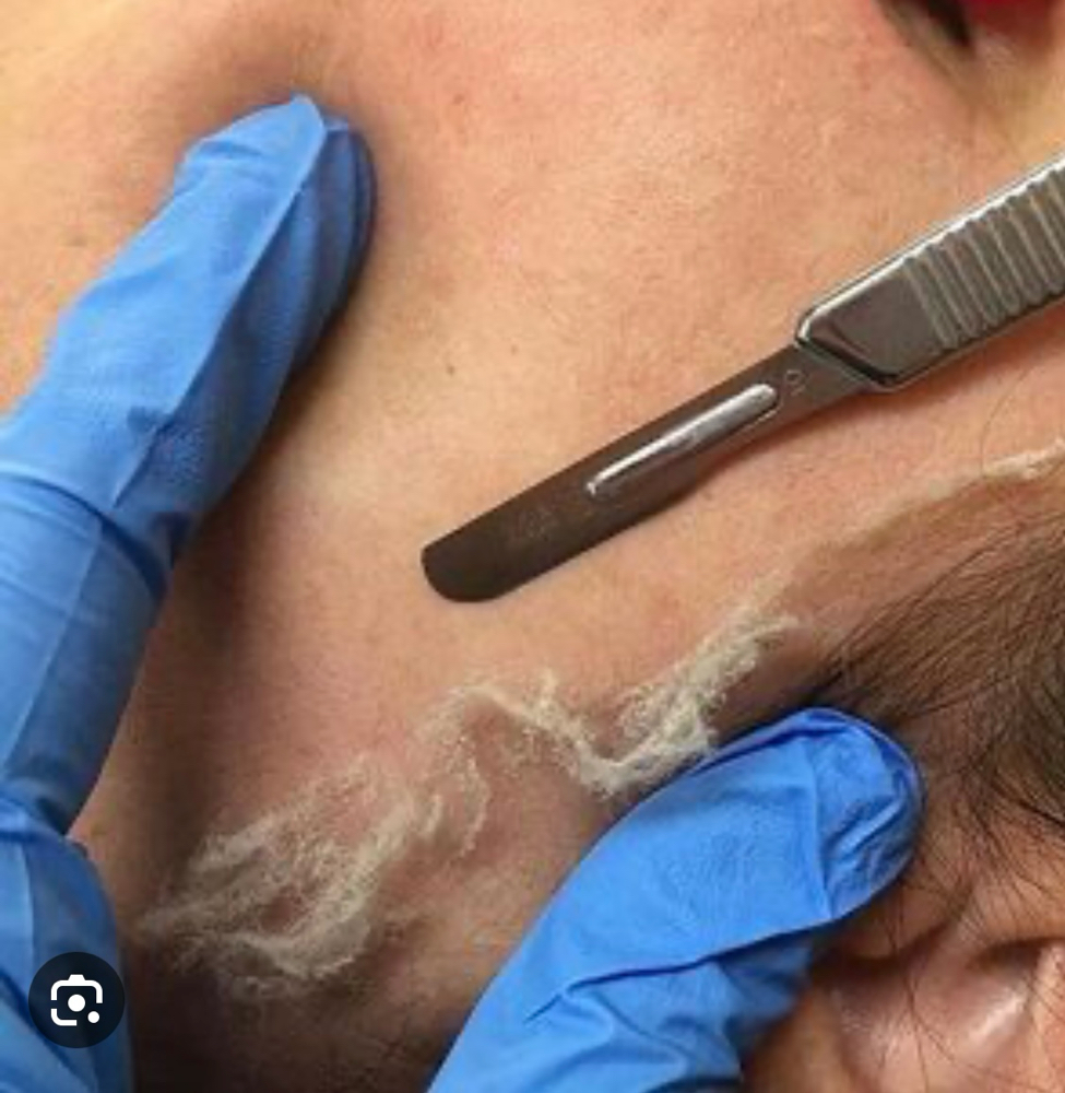 Wet Dermaplaning