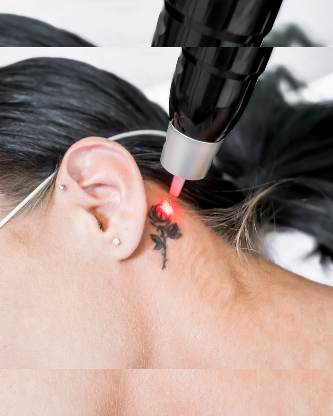 Laser Tattoo Removal