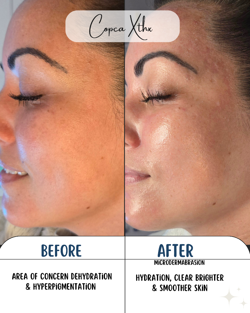 Microdermabrasion