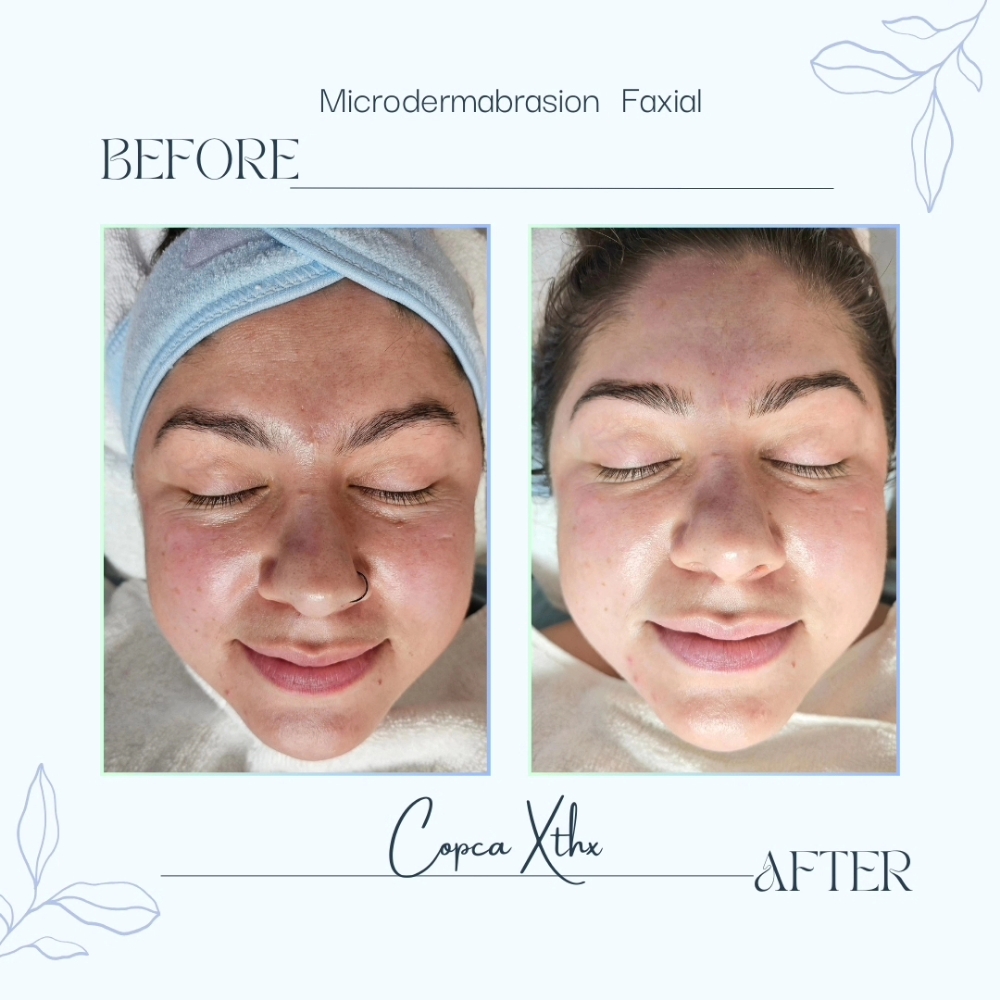 Microdermabrasion