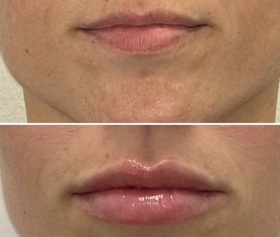 Lip Filler Augmentation