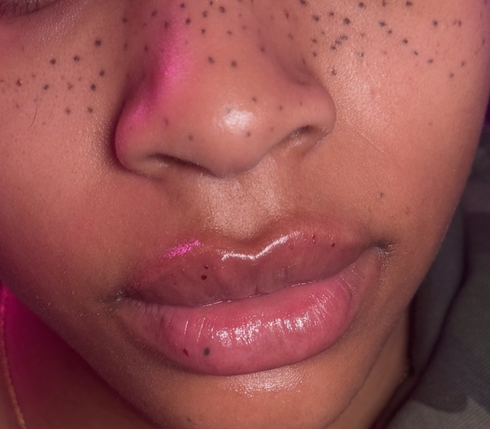 Needleless Lip Filler at TLashCo. in Houston, TX