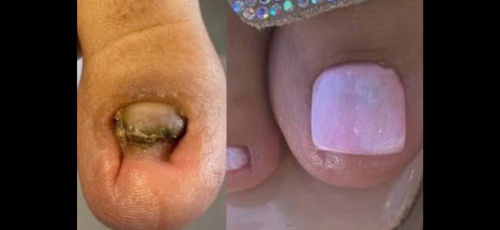 NanoFlex Toe Nail Reconstruction