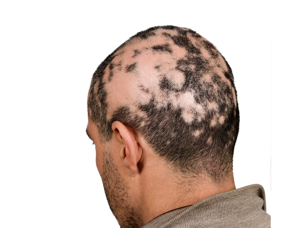 SCALP ALOPECIA