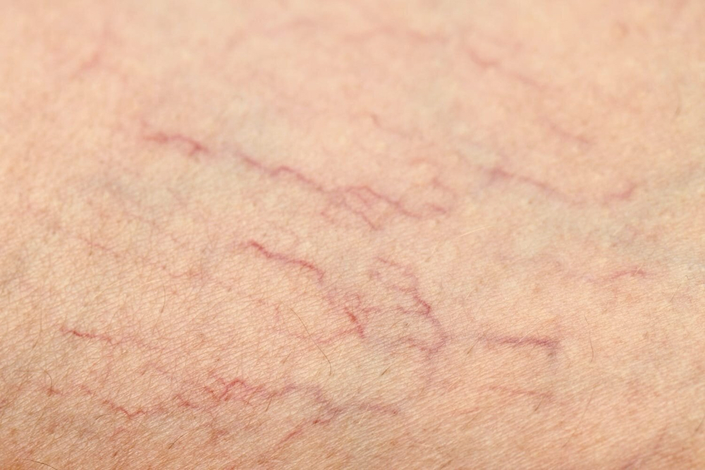 Spider Vein Treatment-small area