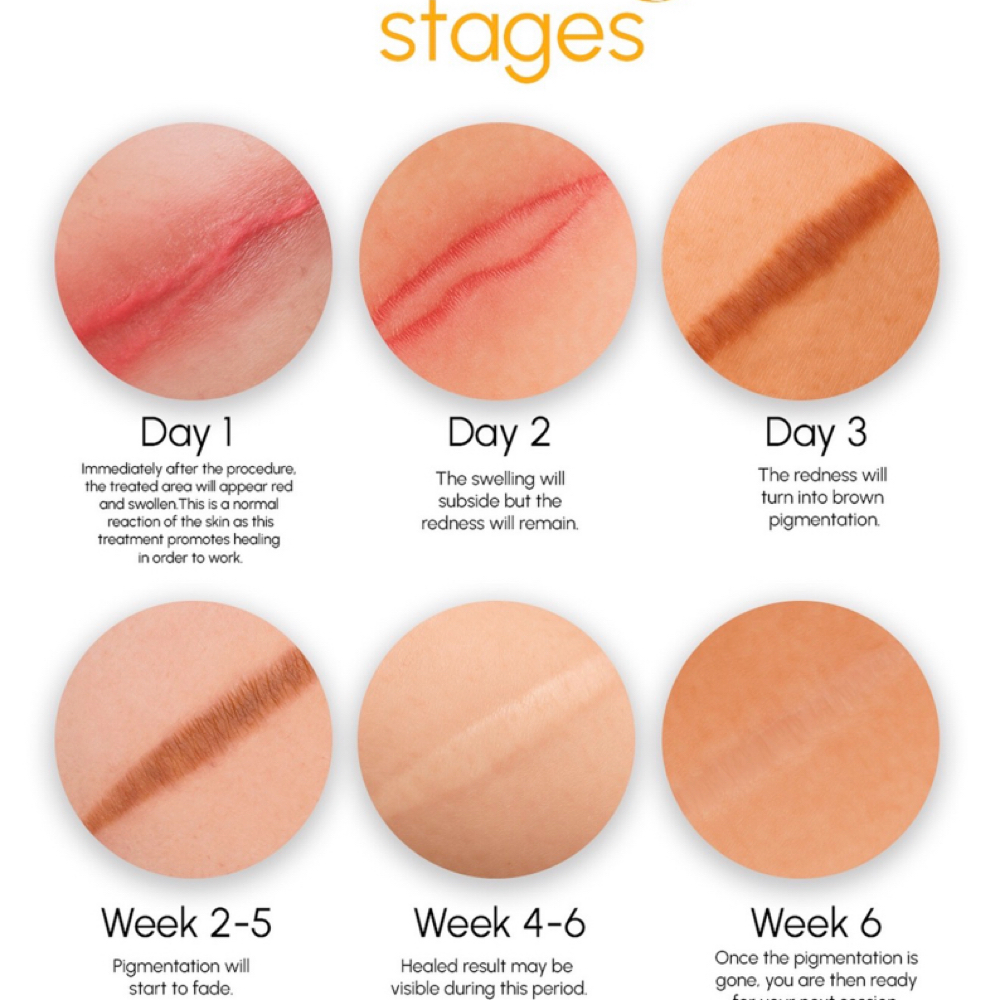 Paramedical Scar Revision at Body Contouring & More in Modesto, CA