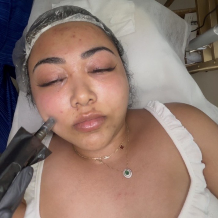 Acne Scar Microneedling at Arewa Essential Medspa in Mamaroneck, NY