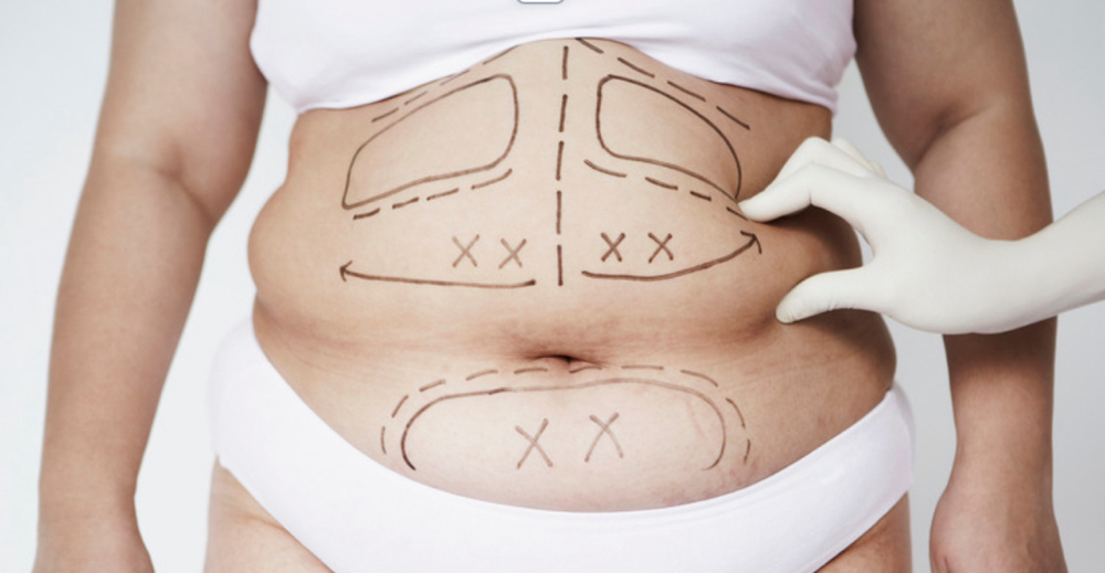 Lipodissolve  Liquid Lipo Treatment