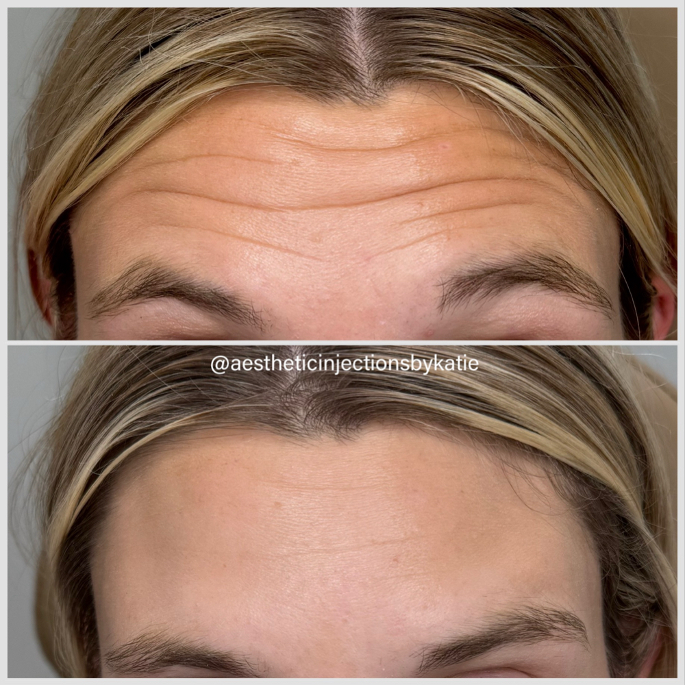Neurotoxin- Wrinkle Relaxer at Aesthetic Injections by Katie in West Plains, MO