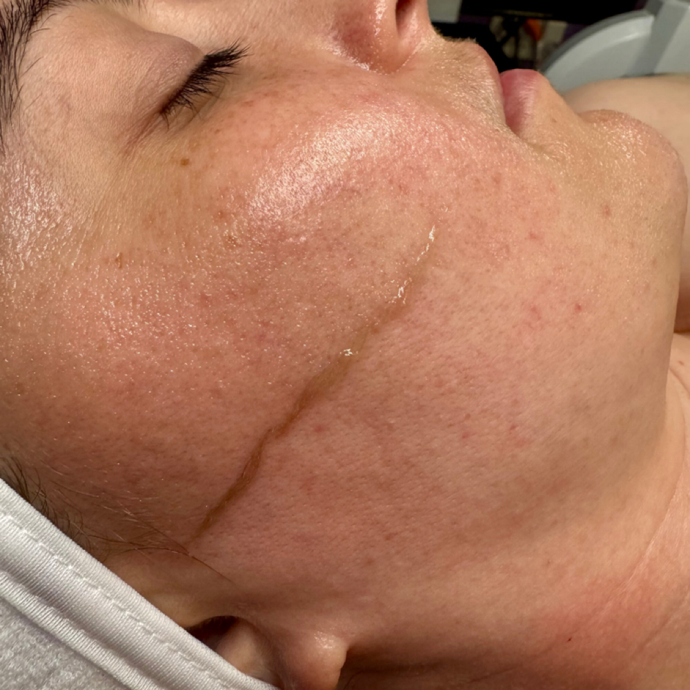 Dermaplane Only at Skin By Carly in LaFayette, GA