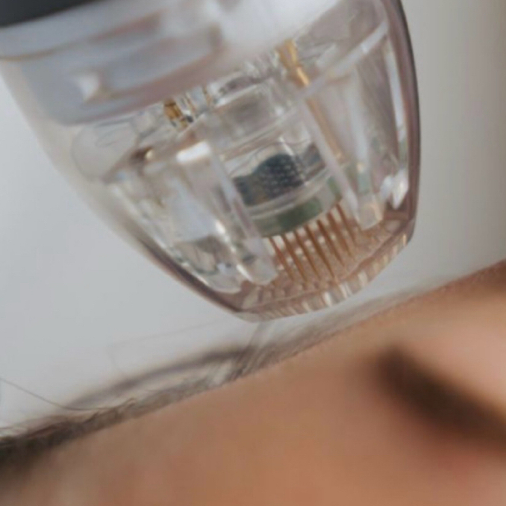 Vybe RF microneedling at Esther Esthetics in Suwanee, GA