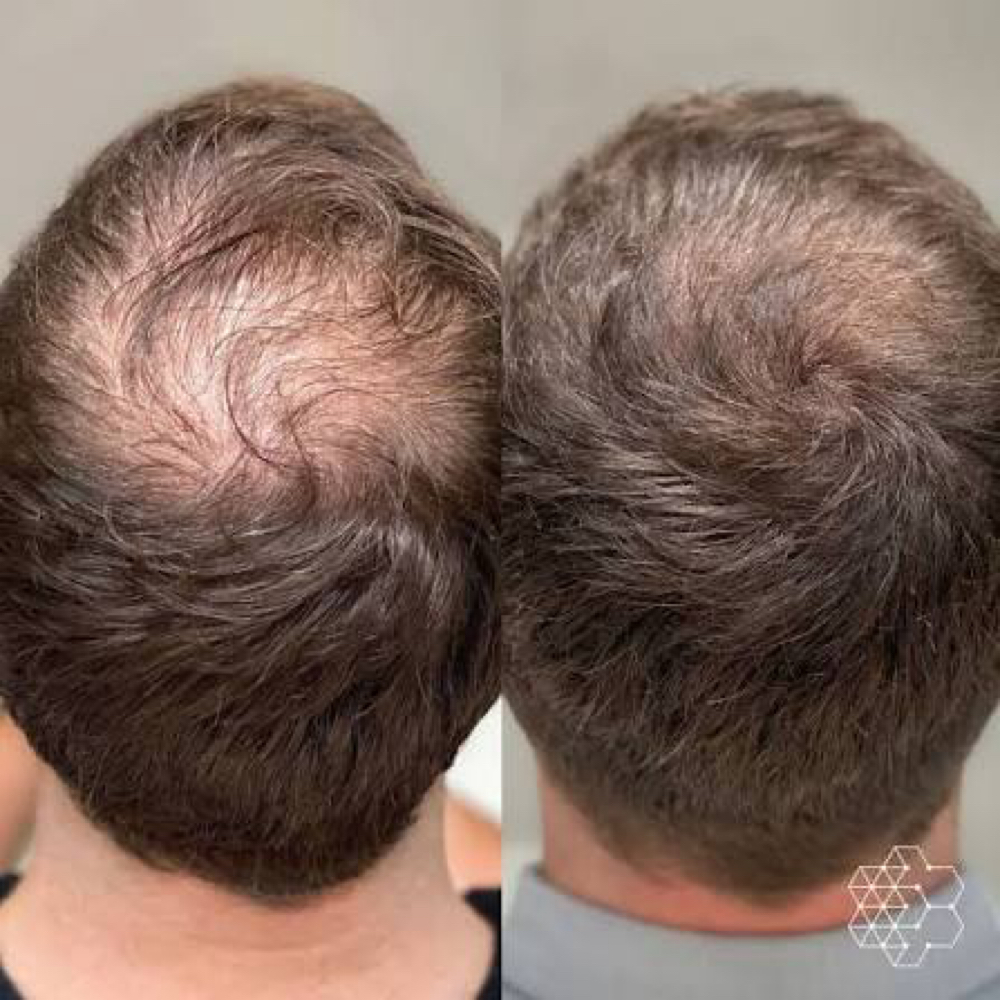 PRP Hair Restoration at DERMÉ Med Spa (formerly LA Lash and Laser Med Spa) in Loveland, CO