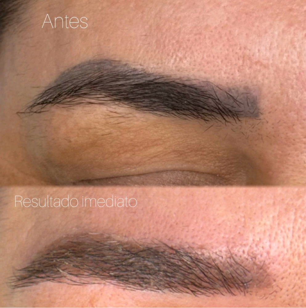 PMU Removal Laser at sofia dias in gloucester, MA
