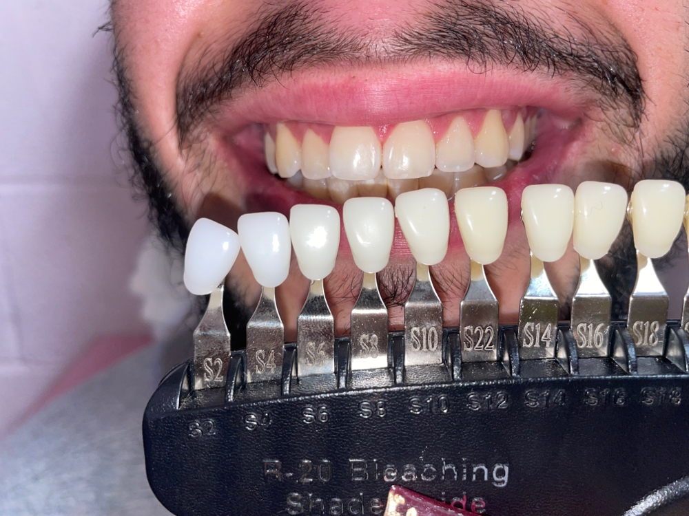 Teeth whitening