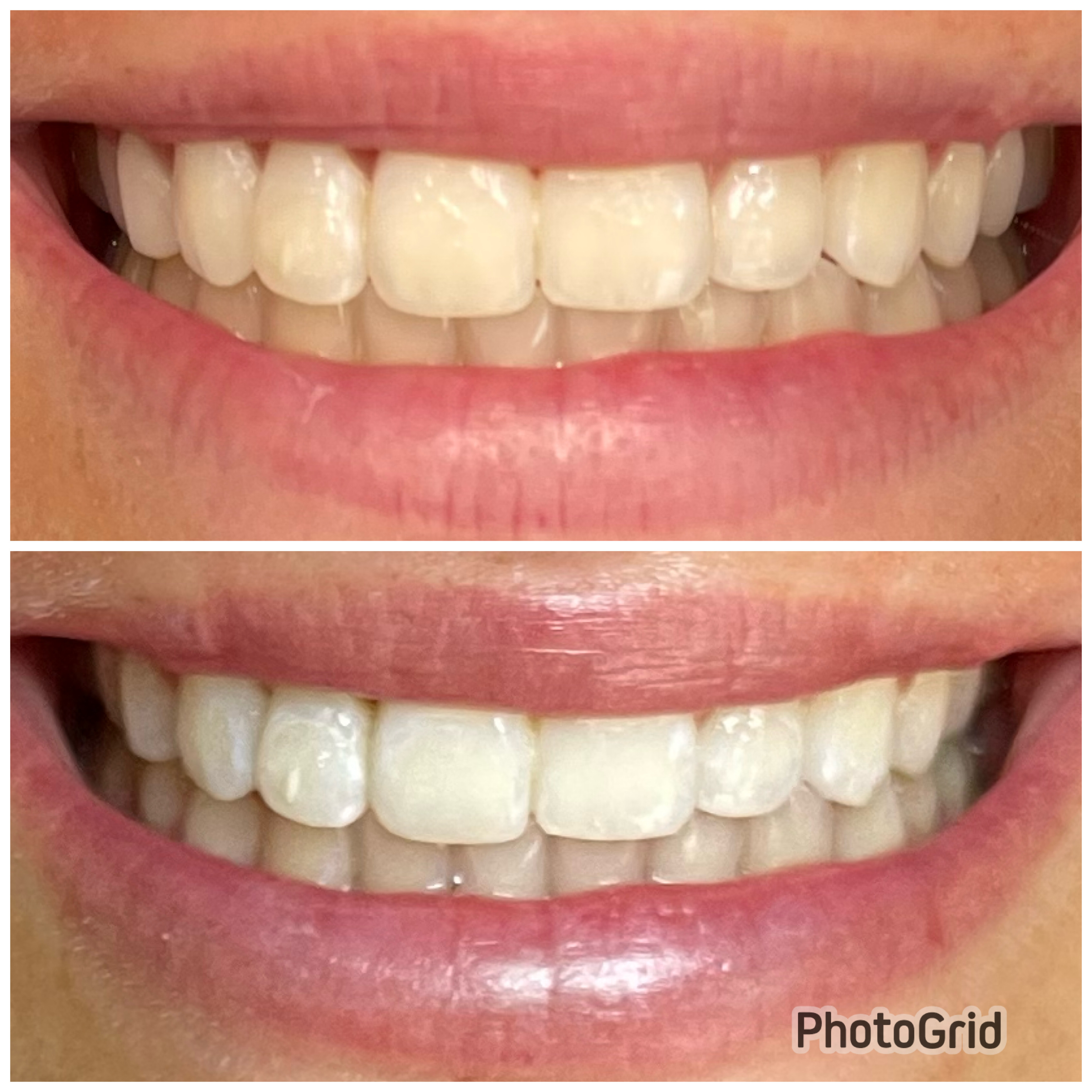 20 MINUTE (TOUCH-UP) WHITENING