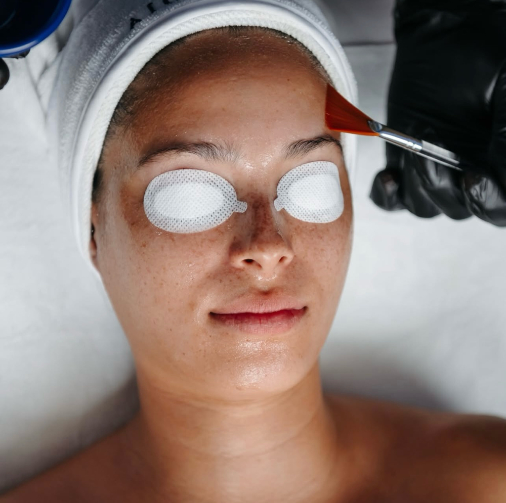 Chemical Peel