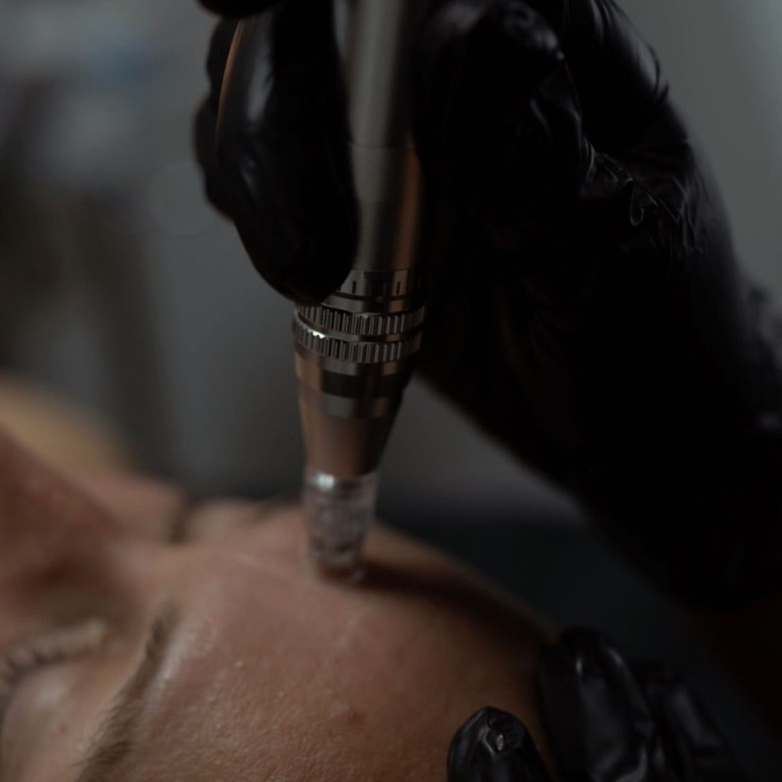Microneedling at THE MED BAR in Colorado, CO