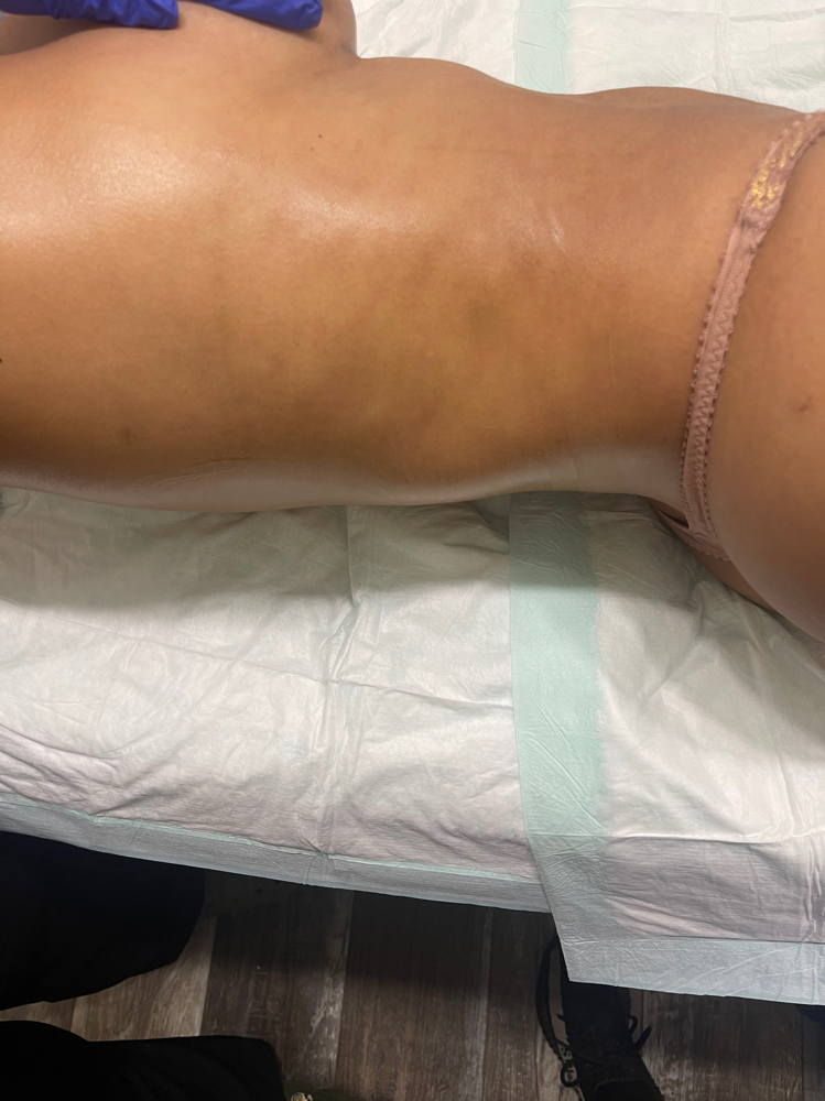 Fibrosis Treatment 10 Sessions