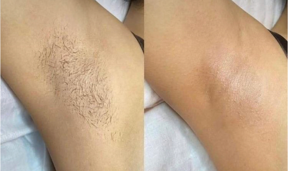 Underarm Wax