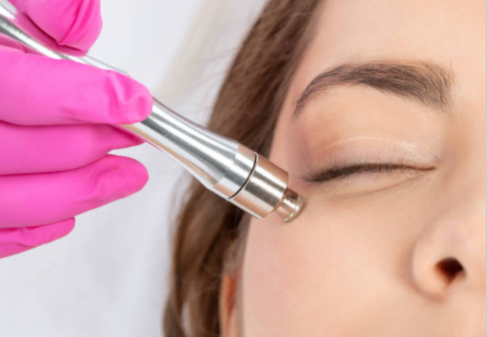 Diamond Microdermabrasion