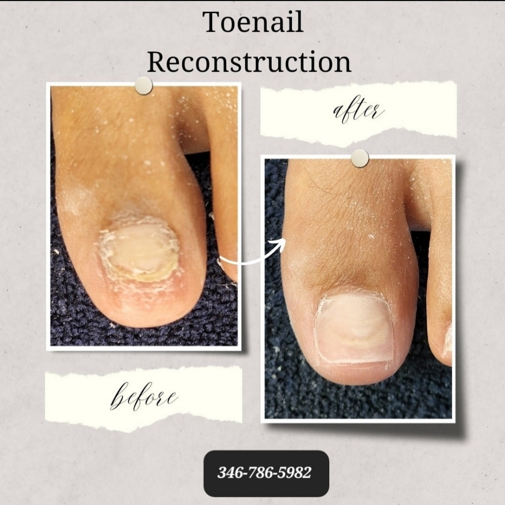 Toenail Reconstruction at ENB Nails in Conroe, TX