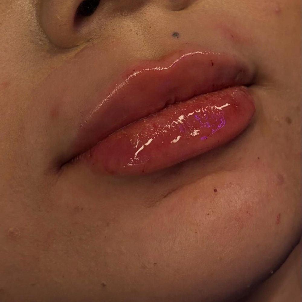 1mL Lip Filler at The Needle Studio Tx in Cleburne, TX