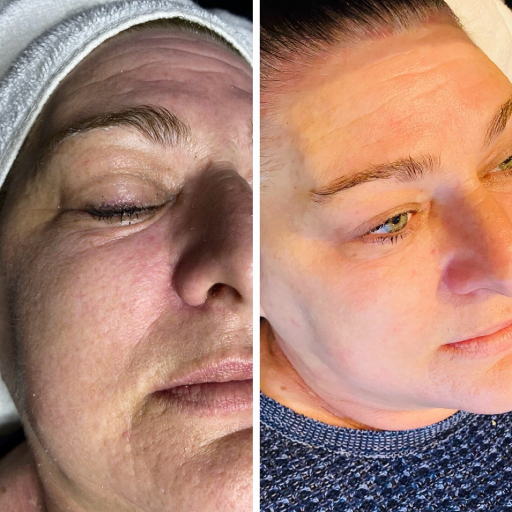 VIP Ultimate Glow & Lift Facial at Lumeva Aesthetic  L.L.C in Maryland, MD