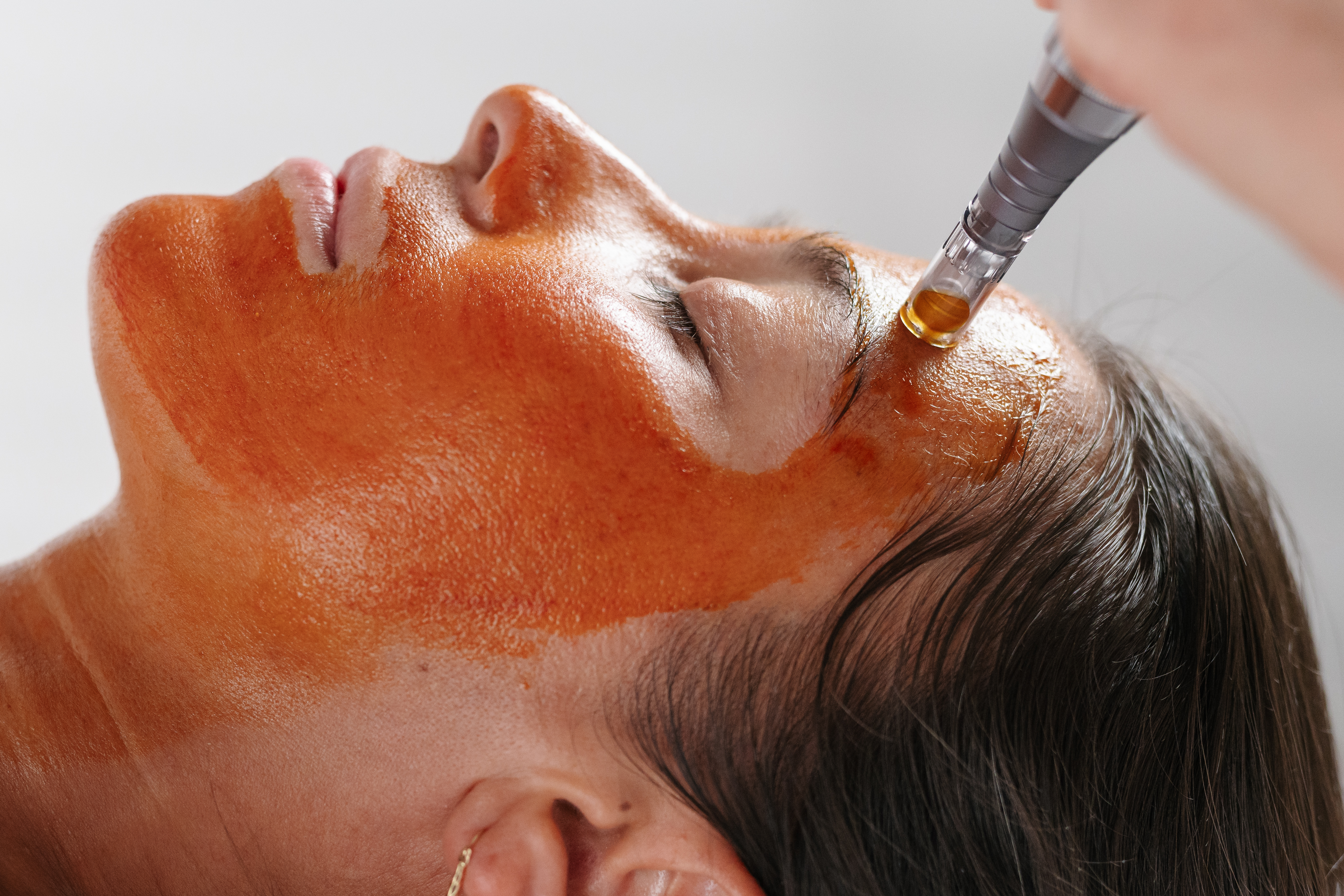 Revitapen Facial Infusion