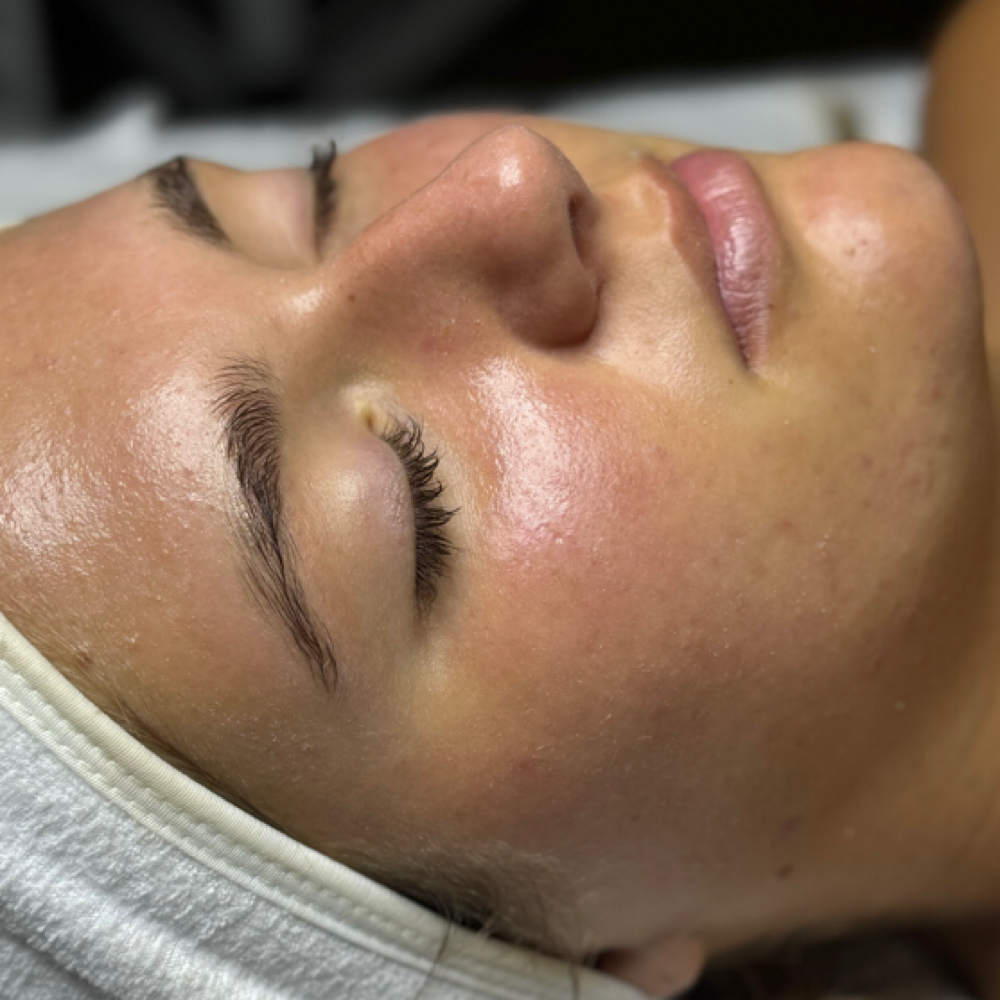 Dermaplane Facial at Bare Skin Aesthetics in West Palm Beach, FL