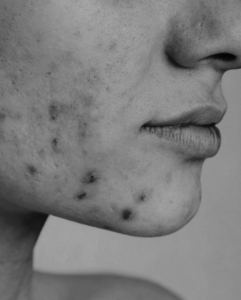 Purifying Facial