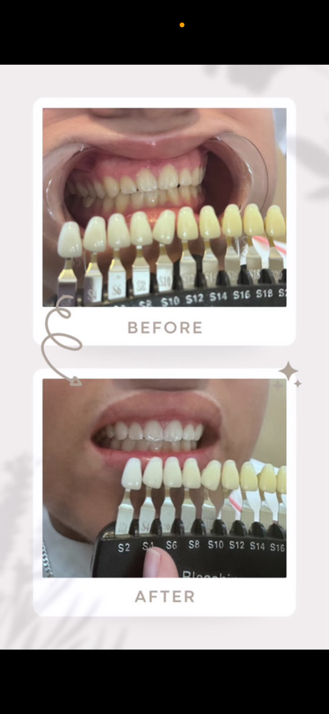 Teeth Whitening- 60 MIN