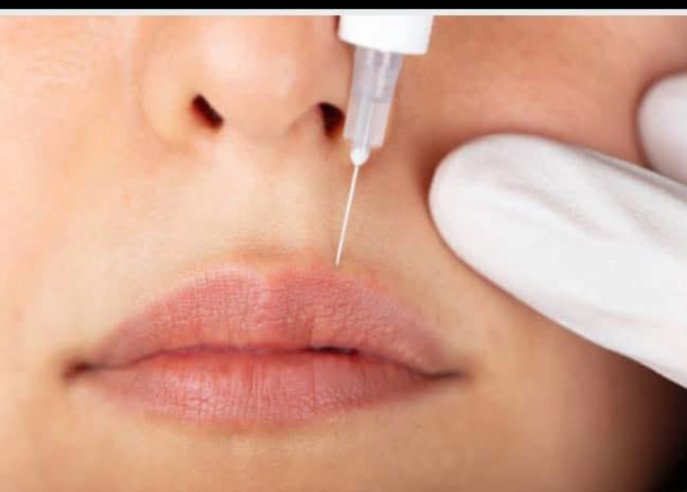 Lip Filler