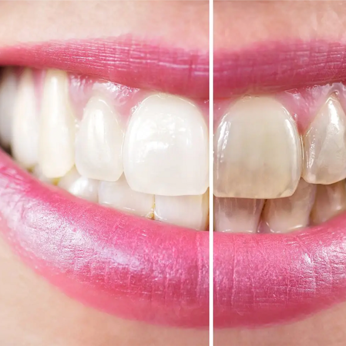 Cosmetic Teeth Whitening 1 Session at Beauty By Angel in Lebanon, KY