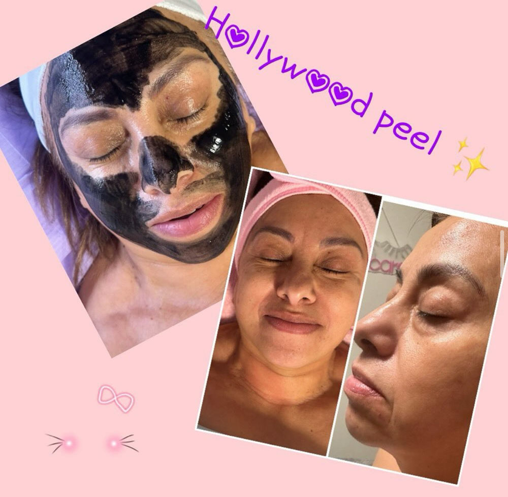 Hollywood Peel