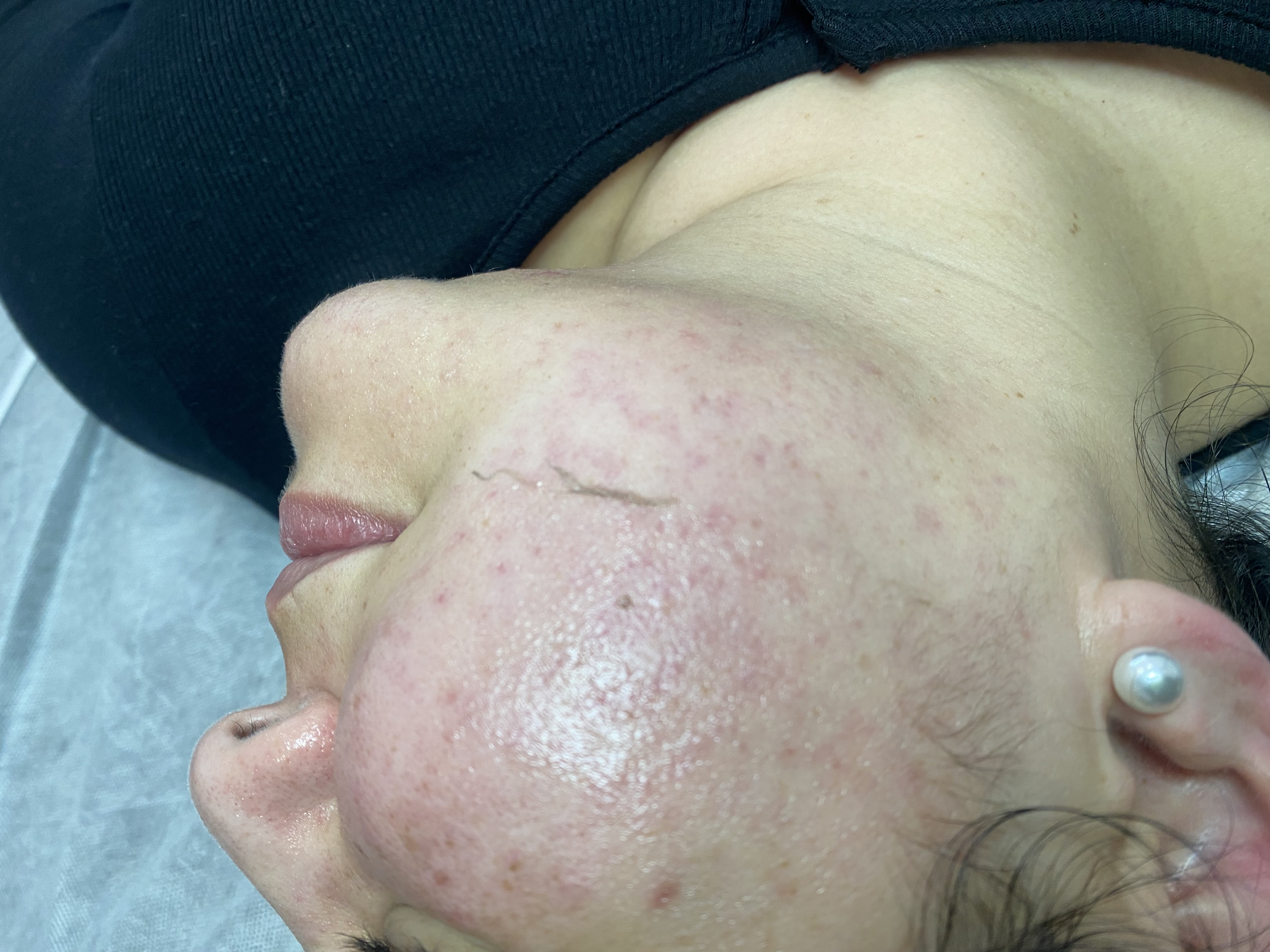 Dermaplane Facial