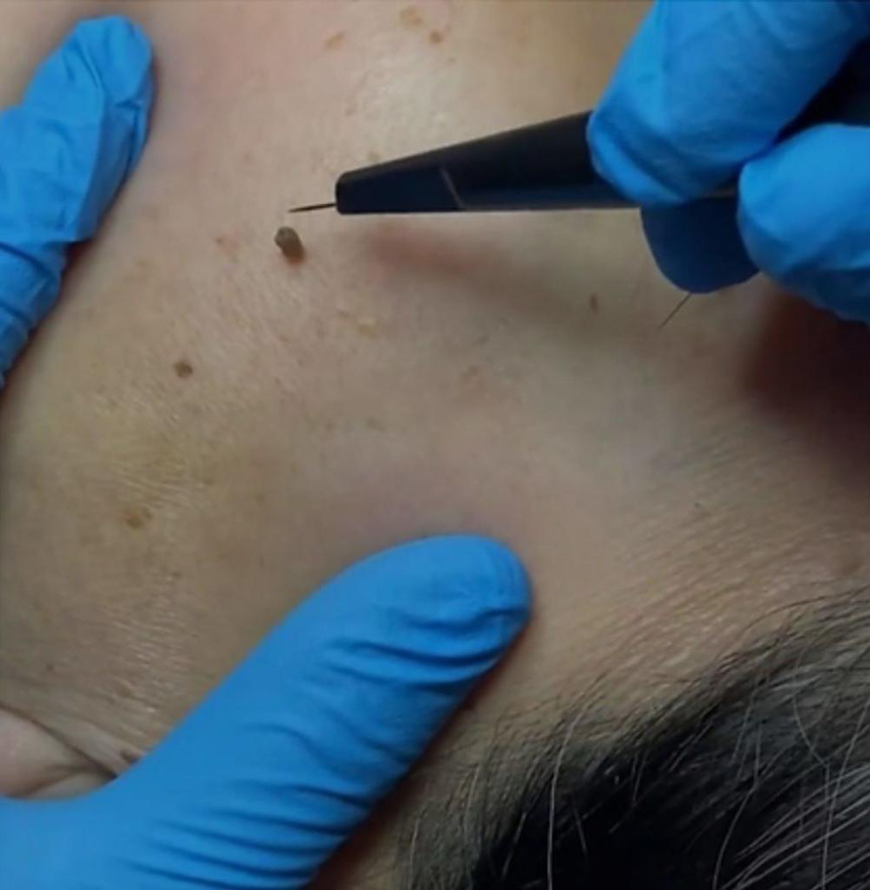Skin Tag Removal