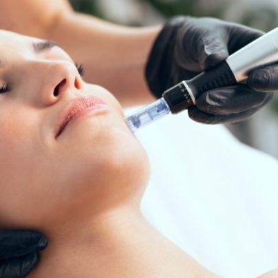 Microneedling at Skincare Factory in Tempe, AZ