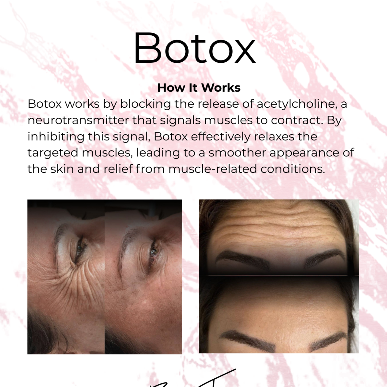 Botox Injections at Leann Renee Aesthetics in St. Peter's, MO