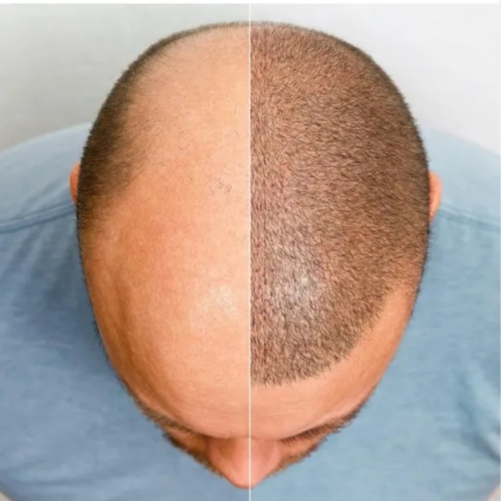ANNUAL SCALP MICROPIGMENTATION
