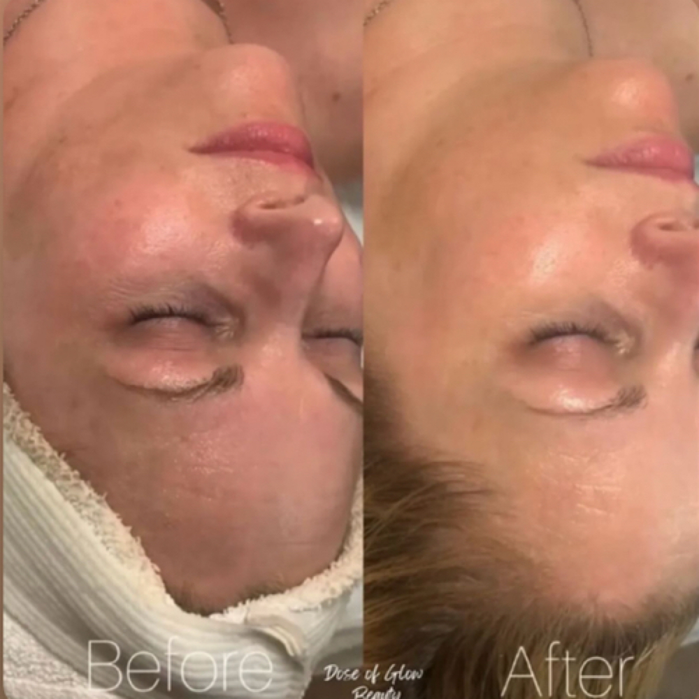 *NEW CLIENT* intro Facial at Dose of Glow in Phoenix, AZ